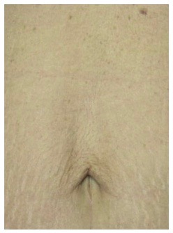 Skin Tightening After Treatment